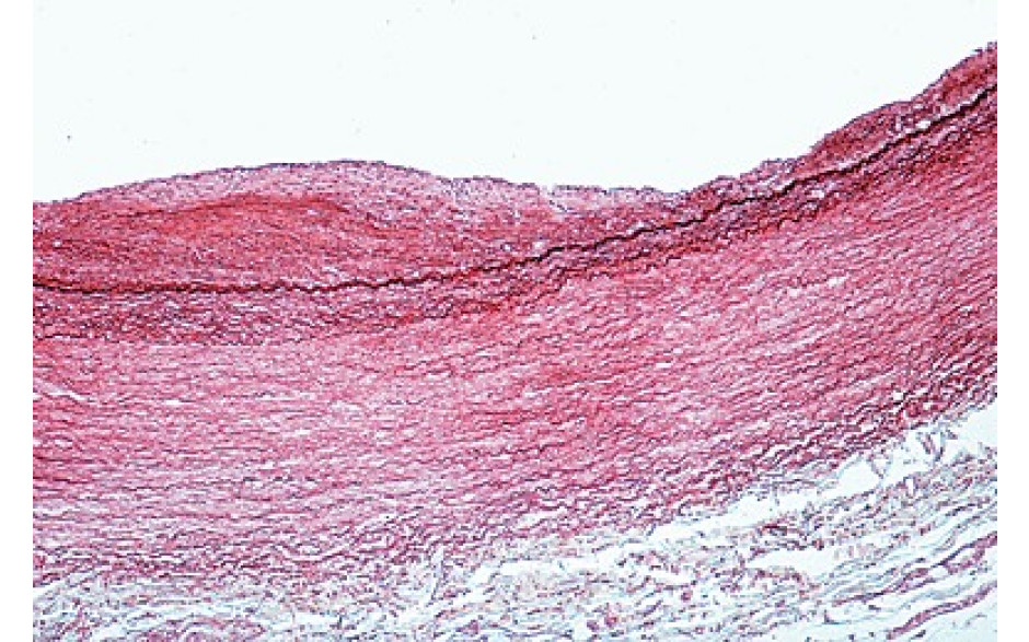 Mikropräparat: Arterienverkalkung des Menschen