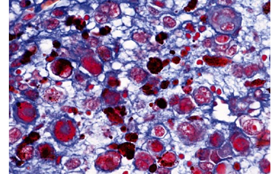 Mikropräparat: Krebs-Metastasen Leber des Menschen